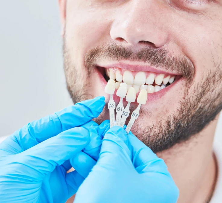Detaillierte Farbabstimmung mit dem Patienten. Farbabgleich